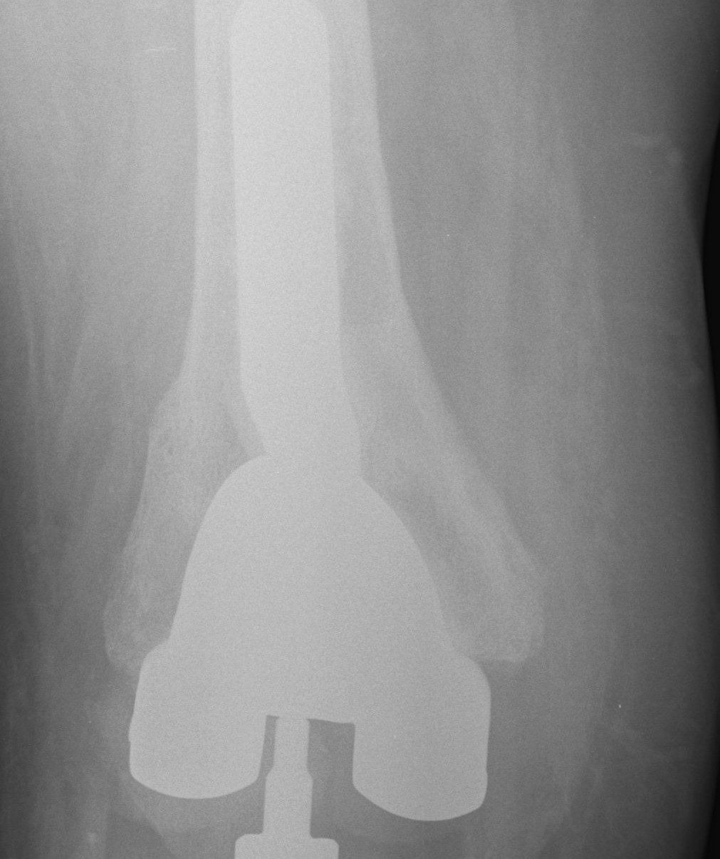 Revision TKR Offset Femoral Stem